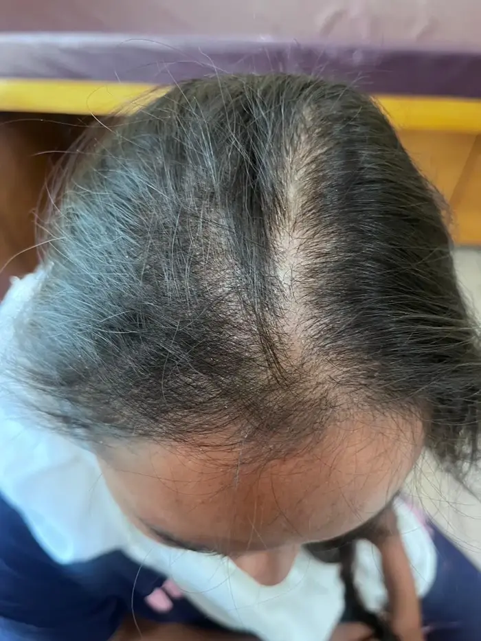 Female Pattern Baldness case 5 before treatment